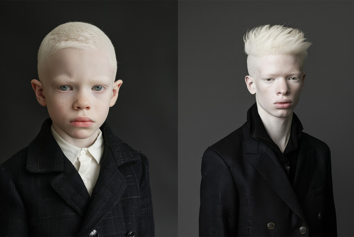 Albinos 4
