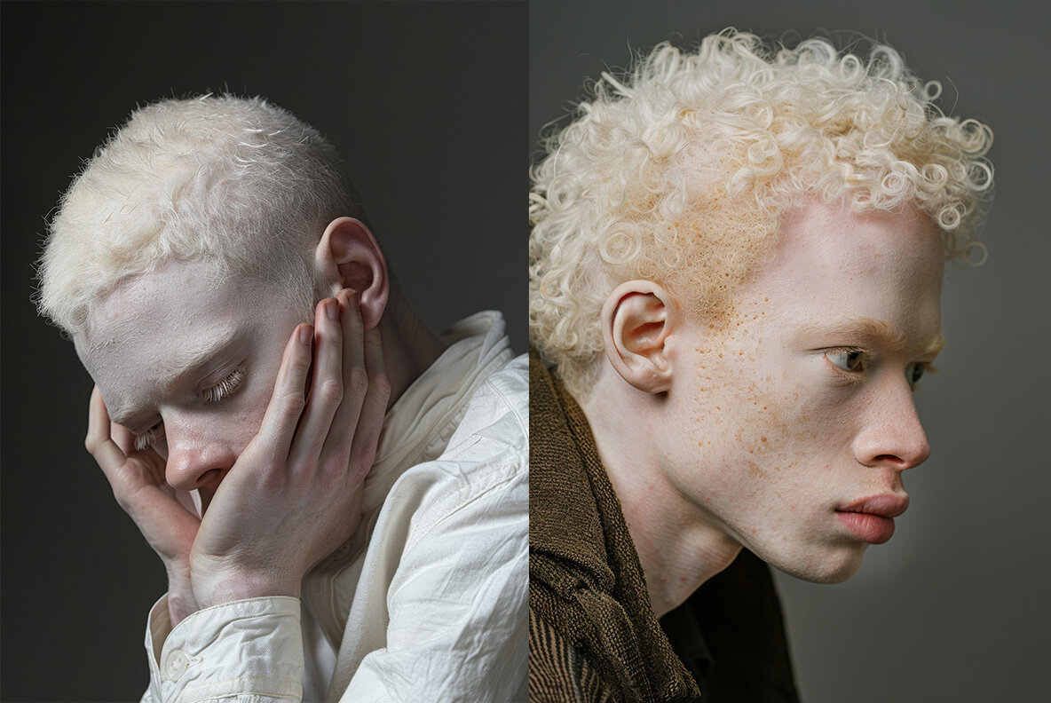 Albinos 9