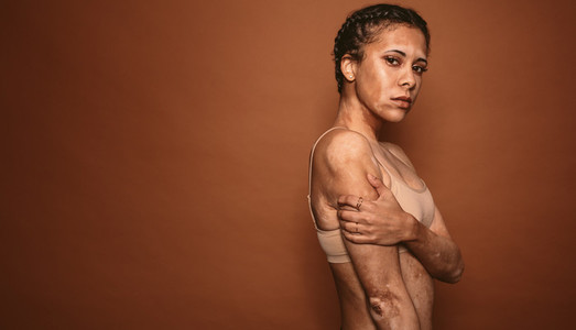 Vitiligo affected young woman in studio