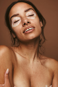 Confident woman with vitiligo