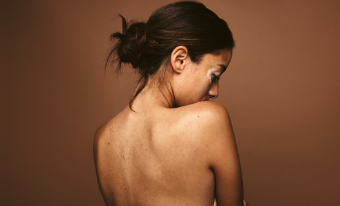 Portrait of woman with skin condition