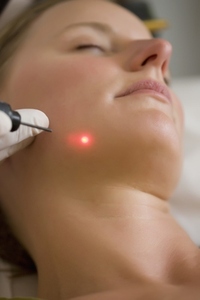 Close up of a woman receiving a laser treatment on her face